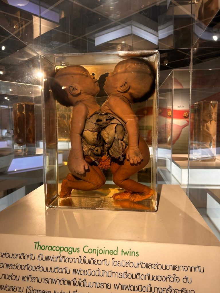 Photo of real corpses of Siamese twins in the Siriraj Medical Museum in Bangkok, Thailand. Foto de cadáveres reais de gêmeos siameses no Museu Médico Siriraj em Bangkok, Tailândia.